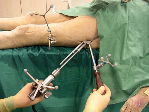 Figure 4. Combination of the navigated PDG with drill sleeves and the navigated drill bit in a cadaver trial during navigated fixation; both the navigated drill and the parallel drill guide (PDG) are displayed on the screen. The reference array on the bone is placed 20 cm distal to the surgical field.