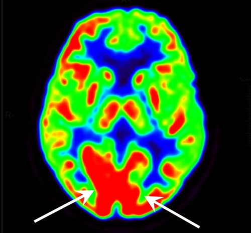 Figure 8 PET-CT imageof Hoehn–Yahr stage 3 patient without freezing of gait. Two white arrows indicate hypermetabolism of bilateral primary visualcortex.