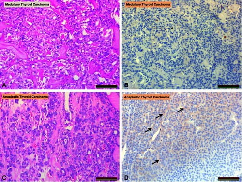 Figure 4 Comparison of irisin expression in medullary thyroid carcinoma and anaplastic thyroid carcinoma. (A) Medullary thyroid carcinoma (H&E staining). (B) Medullary thyroid carcinoma (irisin staining). (C) Anaplastic thyroid carcinoma (H&E staining). (D) Anaplastic thyroid carcinoma (irisin staining). Arrows show irisin immunoreactivity (black arrows).Abbreviation: H&E, hematoxylin and eosin.