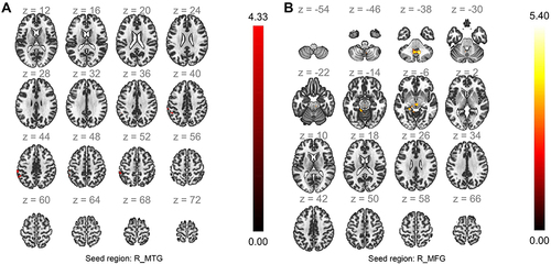 Figure 5 Map of brain regions showing increased FC with seed of R_MTG and R_MFG induced by acupuncture (A) and (B). Hot color represents increased FC brain region with seed, and colorbar represents T value.