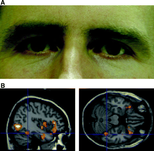 Figure 1.  (A) Example of male face stimulus illustrating mild pupillary dilatation (image 13 of 24). (B) Right fusiform face area activation in response to the main effect of viewing faces. Plotted at p=.005 for illustration, only clusters of 50 or more voxels shown.