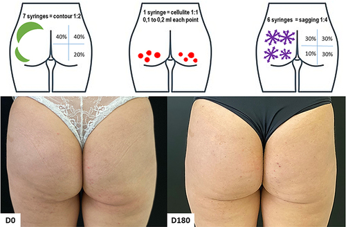 Figure 13 Case 7, Buttocks Beautification 3D. Schematic representation of the injections (above). Standardized posterior images pre and 180 days post injection (below). Each syringe = 1.5 mL of CaHA.