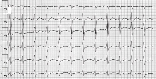 Fig. 1.  Precordial ECG leads recorded on arrival at hospital 9:33 pm (case 1) displayed sinus tachycardia, 146/minute, a slightly widened QRS complex (104 ms) and a prolonged QTc time (555 ms).