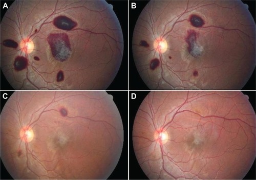 Figure 3 A: a 14-year-old patient with bilateral-layered subinternal limiting membrane involving the fovea in the left eye with prominent striae of the internal limiting membrane. B: 2 weeks later, the fovea is half covered by preretinal hemorrhage with epiretinal membrane formation. C: 3 weeks after last photograph, the preretinal hemorrhage has resorbed. D: 40 days thereafter, the epiretinal membrane is less prominent.