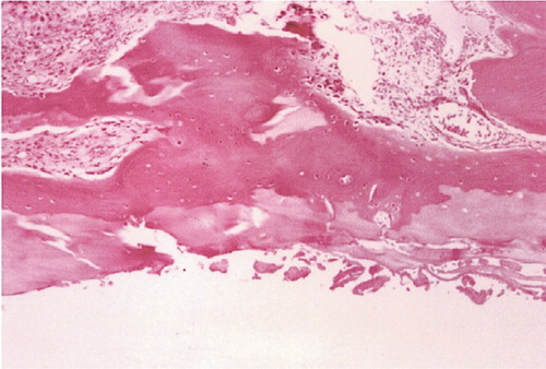 Figure 4. Type IV: disappearance of the fibrocartilage layer and exposure of the osseous layer (×100).
