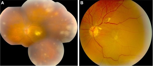 Figure 2 Acute retinal necrosis with macular and optic nerve involvement (case 5).