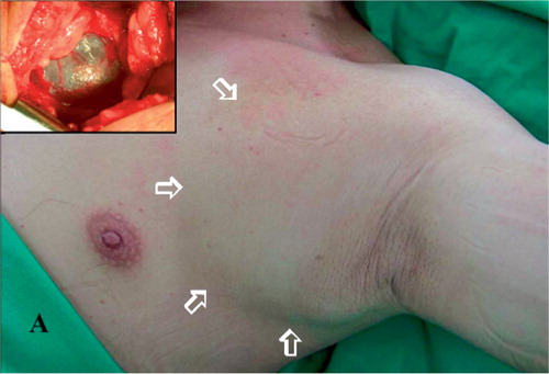 Figure 1. (A) Photograph showing a large ballotable mass over the left infraclavicular fossa and axilla. The inset shows the intraoperative view of the tumor. Note the characteristic appearance of a cystic hygroma, containing clear serous fluid and encapsulated with a thin membrane.