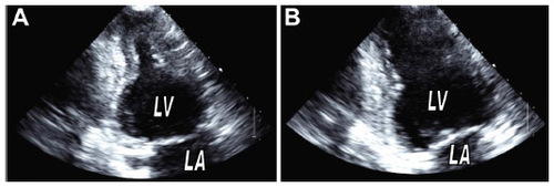 Figure 3 (A and B) Echocardiography demonstrating inverted takotsubo cardiomyopathy.