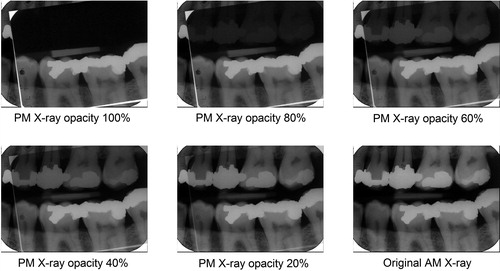 Figure 3. X-ray superimposition. Superimposing the images demonstrates the similarities between the dental features in an intuitive way. (Image courtesy Health Support Queensland Forensic and Scientific Services (HSQ FSS) and the Queensland State Coroner, with permission).