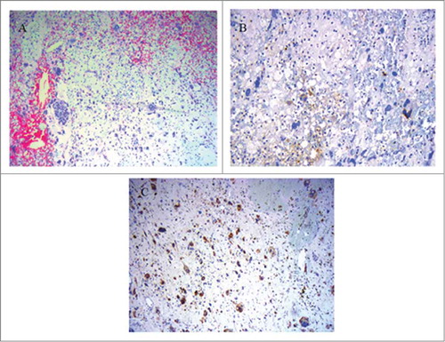 Figure 2. Microscopic features of the grade 4 unclassified renal cell carcinoma, with sarcomatoid component (URCCSC). (A) Patternless arrangement of tumor cells with pleomorphic and spindle cell morphology (H&E x10). (B) Focal immunopositivity for Keratins of neoplastic cells, showing epithelial differentiation. panCK (AE1, AE3,PCK26 clone) (H&E x 25). (C) Immunopositivity for S-100 of neoplastic cells. S-100 clone (H&E × 25).