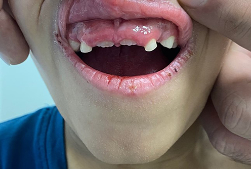 Figure 3 Retention of primary teeth with gum hyperplasia.