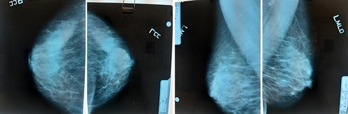 Figure 1 Bilateral mammography with nodular images in the left breast.