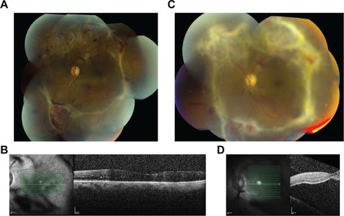 Figure 1 Progression of diabetic tractional retinal detachment, by fundus photography and optical coherence tomography (OCT) of the left eye after a unilateral, right eye intraoperative intravitreal bevacizumab injection.