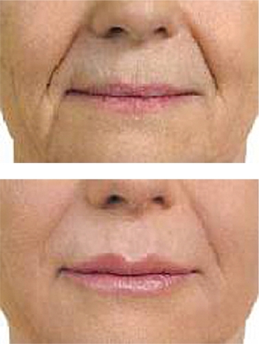 Figure 5 A clinical example of the use of Juvederm™ for nasolabial folds.