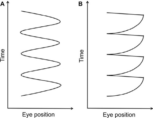 Figure 2 (A) Pendular and (B) jerk waveform patterns in IN.