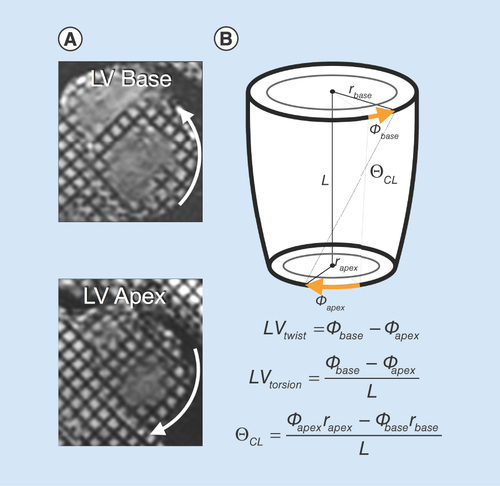 Figure 6.  Analysis of cardiac rotational mechanics using MRI (MRI). (A) MRI tagging at the base and apex can be used to estimate left ventricular rotational mechanics, including (B) left ventricular twist, torsion and CL shear (θCL).LV: Left ventricular; CL: Circumferential–longitudinal.