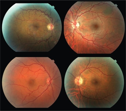 Figure 2 Representative fundus photographs from patients with OSA demonstrating increased tortuosity of the retinal vasculature.