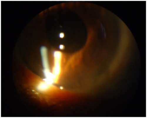 Figure 3 Right eye – mild anterior uveitis with cells.