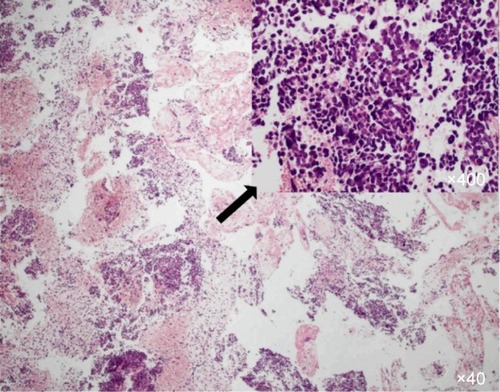 Figure 1 Hematoxylin and Eosin staining of a metastatic specimen in left subphrenic space by endoscopic ultrasound-guided biopsy showing small cell carcinoma.
