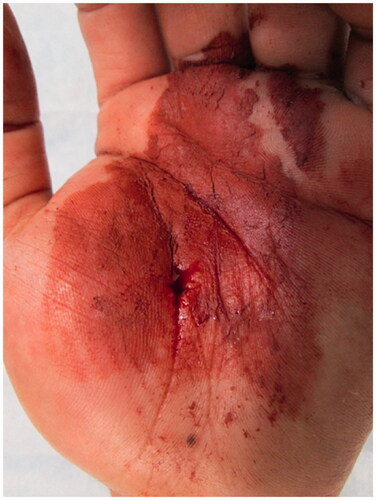 Figure 1. A small wound is observed on the thenar aspect of the thumb, and the paint is attached to the surrounding wound.