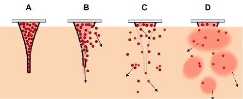 Figure 8 Step-wise illustration of the controlled dermal delivery of a lipophilic drug by NLC-MNs.Notes: (A) Immediately after the application of the NLC-MNs to the skin. (B) Bioerosion of the MNs to release the NLCs carrying the drug. (C) Liberated NLCs diffuse and/or partition into the dermal layer while releasing the drug. (D) Drug is totally exposed and orientates to the target sites in dermal tissue. Solid black or grey lines represent the surface of the MNs as intact or eroded, respectively. Red colored circles represent the NLCs containing NR (as a model lipophilic molecule).Abbreviations: NLC-MNs, nanostructured-lipid-carrier-loaded microneedles; NR, nile red; MNs, microneedles; NLCs, nanostructured-lipid-carriers.