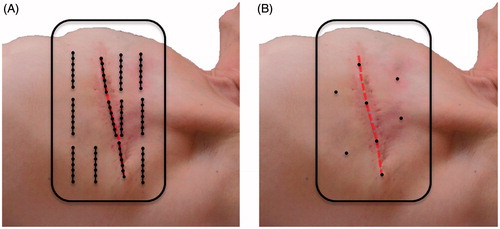 Figure 1. Typical placement of superficial temperature sensors in a previously irradiated area during a superficial hyperthermia treatment of a patient with recurrent breast cancer. (A) At the AMC, multiple 7-point thermocouple probes are placed in the target region, three or four probes are placed in areas with low perfusion, such as the surgical scar (red dashed line), and the remaining probes are spread out over the target region. (B) Most other users spread limited single temperature sensors to maximize coverage of the target area.