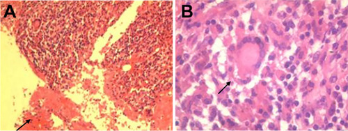 Figure 2 Histopathological sections of chest wall TB lesions, showing necrotic material (A) and granulomatous lesions with multinucleated giant cells (B). Pathology confirmed that the lesion was tuberculous granulomatous inflammation.
