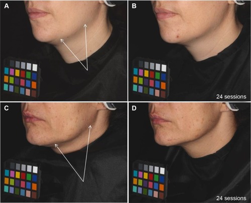 Figure 7 Skin sagging evolution during the study: examples on two volunteers treated on the left side of the face before and after 24 sessions of treatment.