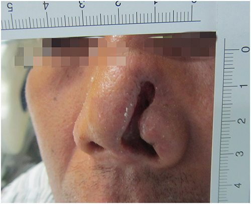 Figure 4 After 12 days of treatments, the left nasal scab fell off and a large tissue defect remained.