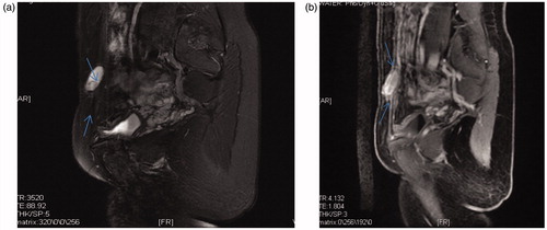 Figure 3. (a) T2-weight MRI of an AWE cyst before the HIFU procedure. (b) T1-weighted MRI of an AWE cyst before the HIFU procedure.