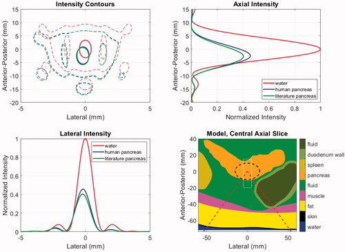 Figure 6. Acoustic intensities for patient model M1 using literature and newly acquired human pancreas acoustic properties. The model geometry (lower right) shows the distribution of tissues and includes the ‘cone’ of the incident HIFU beam (dashed red), the PDAC target (dashed black) and the window in which intensities are displayed in the other panels (thin white). The intensities are shown in the central axial plane of the model (upper left) at levels of 0.7 (thick solid) and 0.033 (thin dashed) relative to the maximum. Axial (upper right) and lateral (lower left) intensity profiles are shown at the level of each model’s maximum value.