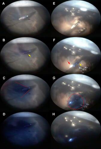 Figure 5 Comparison of the injection stream during IVI with the SHN (A–D) and the NDN (E–H) in cadaver pig eyes. During the initial IVI stage the dye appears on the needle tip of the SHN (B, yellow arrow) and on the side of the NDN needle (F, yellow arrow) while the needle tip remains free of dye (F, red arrow). The dye spreads in conical manner from the SHD (C, red lines) and it spreads around the needle tip of the NDN (G, dashed line). Diffuse filling of the vitreous of the injection site appears to be similar in the case of the SHN and NDN. (Created by L. Lytvynchuk.)