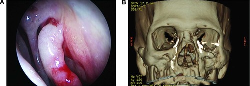Figure 4 Case 2: (A) Endoscopic view of the left nasal cavity showing alteration of the nasal anatomy. (B) The 3D CT-DCG shows an irregular dilated left lacrimal sac and an abrupt obstruction at the level of the proximal nasolacrimal duct. The DCG findings of the right lacrimal apparatus were normal.