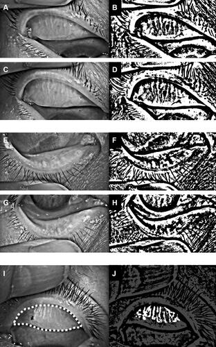Figure 1 Representative measurements of upper and lower eyelid MG loss area (%). Representative measurements of upper eyelid MG by meibography on Keratograph 5M before cataract surgery (A); digitized image from A (B); meibography image after cataract surgery (C); digitized image from C (D). Representative measurements for lower eyelid MG by meibography on Keratograph 5M before cataract surgery (E); digitized images from E (F); meibography after cataract surgery (G); digitized image from G (H). Example of total analysis area (I) and detected MG area (J) used to compute the loss area (%).