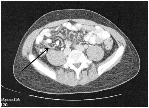 Figure 3. CT slice showing tumour infiltrating between leaves of small bowel mesentery (string of pearls).