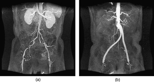 Figure 15. MIP of preoperative and postoperative MRA for a 55-year-old male. (a) shows the extent of the occlusive disease preoperatively (the tight stenosis in the left and right external iliac arteries), while (b) shows the bypass graft. Postoperatively, the distal native aorta and the external iliac arteries are occluded. The postoperative data were acquired 9 days after the surgery.