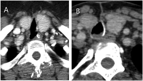 Figure 2. Computed tomography scans two hours after tracheal rupture with no signs of pneumo-mediastinum (A) and six days later showing complete closure (B).
