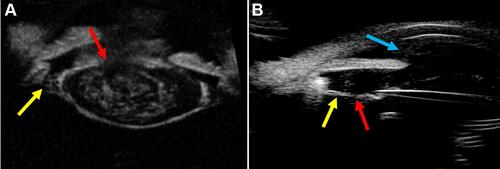 Figure 3 (A) An ultrasound biomicroscopic (UBM) image illustrating zonular stretching (Yellow arrow) with ruptured anterior capsule (Red arrow) in a 24-year-old patient with blunt trauma. (B) An ultrasound biomicroscopic (UBM) image illustrating zonular stretching (Yellow arrow) with zonular tear (Red arrow) along with vitreous in the anterior chamber (Blue arrow) in a 45-year-old patient with penetrating trauma.