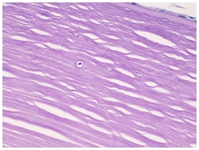 Figure 6 Acanthamoeba cysts within corneal stroma.
