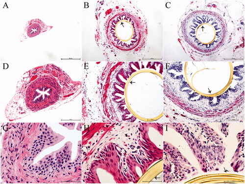Figure 3. Histopathological evaluation of ureters fixed with the polyimide stent at postoperative week 12. Panels A, B, and C are images acquired at a magnification of 4×, panels D, E, and F represent the same images acquired at a magnification of 10×, and panels G, H, and I represent the same images acquired at a magnification of 40×, (A, D and G) Tissues from group I (n = 7), exhibiting normal features. (B, E, and H) The polyimide stent in group II (n = 7) is still in place, with the tissues around the stent appearing intact. (C, F, and I). The polyimide stent in group III (n = 7) is also in place, with the ureteral epithelium enclosing the stent appearing complete. A few inflammatory cells can be seen in the ureteral tissues. The arrows in the images indicate the ureteral stent.