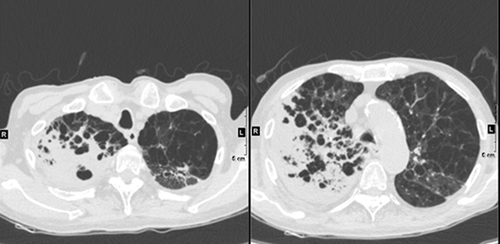 Figure 1 Chest high-resolution computed tomography revealed a patchy high-density shadow with an unclear boundary and infectious disease in the right lung.