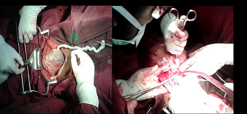 Figure 7 Placenta in the peritoneal cavity and the narrow placental pedicle attached to the right adnexa being clamped.