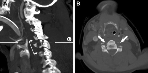 Figure 5 Bilateral vertebral artery dissection in cervical C5/6 facet fractures with dislocation.