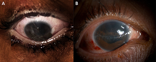 Figure 2 Slitlamp photograph showing (A). Eye with open globe injury. (B) Following repair of globe injury.