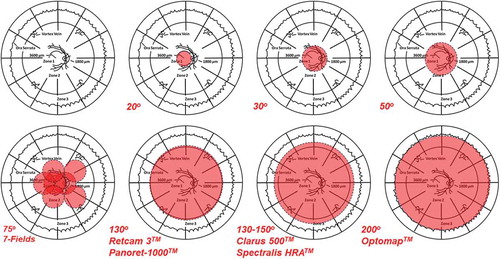 Figure 1. An overview of the extent of imaging capable, shown in red, with traditional photography (30–50°, and slightly beyond), 7-field montage photography of the sort used in many clinical trials (approximately 75°), and various contact (Retcam 3TM and Panoret-1000TM) and non-contact (ClarusTM, Spectralis HRATM and OptosTM) ultra-wide-field photographic imaging systems. A schematic underlay of the proportionate topographic areas of retinal Zones 1,2, and 3 used in describing retinitis is used for orientation, and to show major anatomic landmarks in relation to each of the three zones. After Cunningham ET Jr, Hubbard LD, Danis RP, Holland GN. Proportionate topographic areas of retinal Zones 1, 2, and 3 for use in describing infectious retinitis. Arch Ophthalmol. 2011 Nov; 129(11):1507–1508.