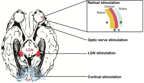 Figure 2 Locations of vision prostheses.