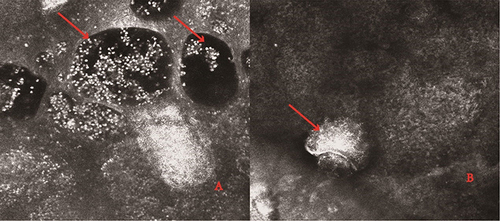 Figure 3 Reflectance confocal microscopy images: (A) tunnel in the stratum corneum or granular layer, dark oval structures corresponding to vesicles with red arrows. (B) larval body and claw-like structures with red arrows.
