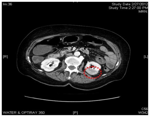 Figure 1 Computed tomography abdomen with contrast showed a left renal infarct, 8 mm in size.