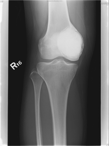 Figure 6. Antero-posterior radiograph of the knee of Case 4 at 6 months post-surgery, showing cementation of the bone defect after tumor removal.