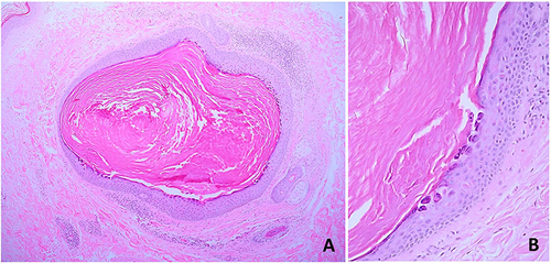 Figure 4 Histopathological findings: (A) cystic dilatation with keratotic follicular plugging (hematoxylin-eosin, original magnification x10) and (B) focal acantholytic dyskeratosis in the cystic epithelium (hematoxylin-eosin, original magnification x100).